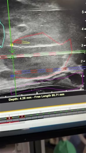 LDR brachytherapy is the fastest method of radiation therapy for eliminating locally advanced prostate cancer. This three-hour, minimally invasive procedure ensures high clinical effectiveness while… | Norbert Piotrkowicz