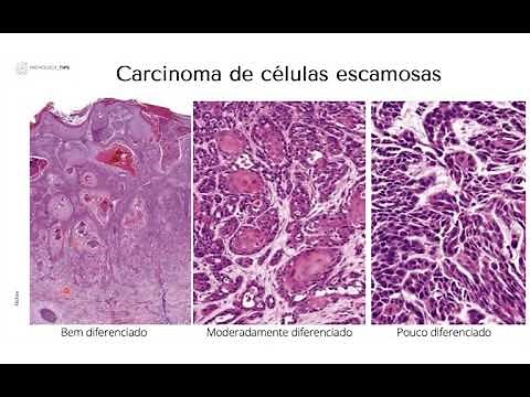 Carcinoma de Células Escamosas