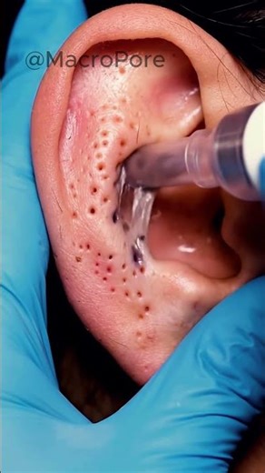 WATCH THESE EAR COMEDONES STRETCH 👂 #asmrshorts #asmr #satisfying