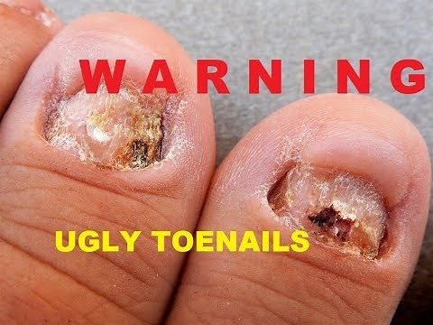 🤢UGLY TOE NAIL Transformation ! --EWWWwww---- FIX THEM w/ DUAL FORMS & ACRYLIC --- SEE HOW