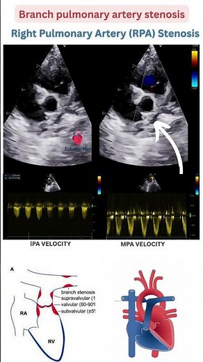 Right Pulmonary Artery (RPA) Stenosis #Echocardiography #PulmonaryArteryStenosis #RPAStenosis