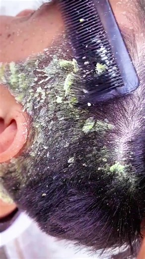 Effective Dandruff Shampoo for Flake-Free Scalp