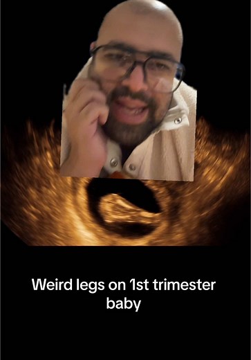 Unusual Ultrasound Findings: Baby's Legs Position Explained