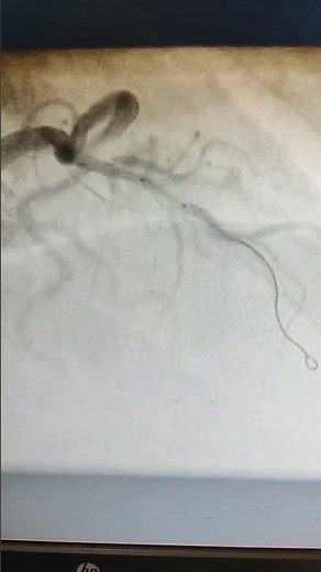 Percutaneous coronary intervention left anterior descending artery [LAD]
