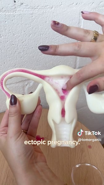 Understanding Decidual Casts in Women's Health