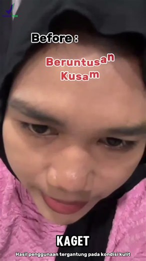 Peeling Serum Ampuh untuk Cerahkan Wajah dan Hilangkan Flek