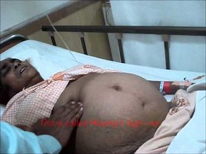 Murphy's Sign in Acute Cholecystitis.