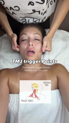 The hidden trigger points behind your TMJ pain #TMJ #jawpain #tmjrelief #tmjpain #tmjdisorder #tmjs