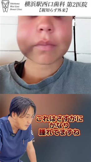 親知らず抜歯後の腫れ状況