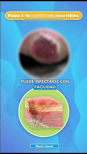 #shorts Las 4 etapas de una escara que debes conocer