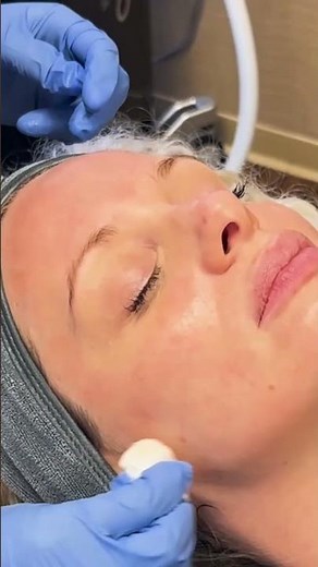 DERMAPLANING & MICROPEEL - Perfect Combo for Soft & Shiny Skin! #skincare #trending #shorts