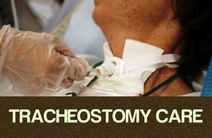35  Tracheostomy Care Techniques for Nurses - NurseBuff
