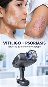 Vitiligo & Psoriasis Treatment: Why 308 NM Excimer Matters