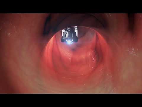 The Flex Robotic System is the first flexible robotic system commercialized for transanal procedures