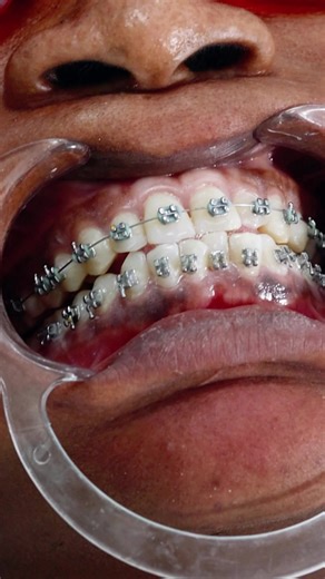 Lower front teeth crowded? Don’t ignore it. Crowding in the lower anterior teeth can cause: ❌ Poor cleaning ❌ Gum problems ❌ Faster tooth wear ❌ Aesthetics concerns With braces or clear aligners, we gently align the teeth, improve oral hygiene, and restore your confident smile ✨ Early assessment makes treatment simpler and faster. 📍 Glowhite Dental Clinic 📞 027 184 2345 | 053 964 7100 Book your smile check today! Hashtags #LowerAnteriorCrowding #TeethCrowding #BracesWork #ClearAligners #SmileT