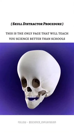 Science on Instagram: "A skull distractor procedure is a surgical method used to gradually expand or reshape bones of the skull, often in children with craniofacial abnormalities like craniosynostosis. Surgeons attach a distractor device to the skull bones after cutting them in a planned way (osteotomy). Over days or weeks, the device is slowly adjusted to pull the bones apart, allowing new bone to form in the gap (distraction osteogenesis). This helps increase skull space and improve shape with