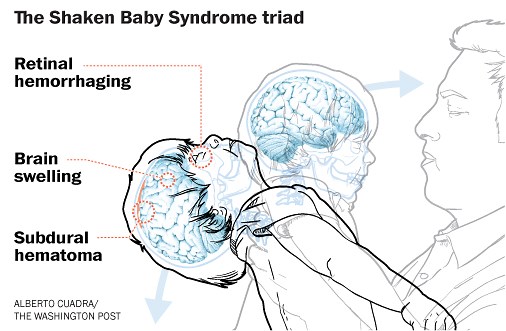 The unsettled science of Shaken Baby Syndrome