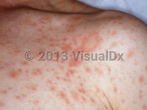 VisualDx - Pityriasis rosea