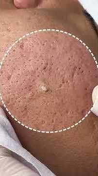 Annoying Blackheads on the Chin: Completely Cleared in Just Minutes!