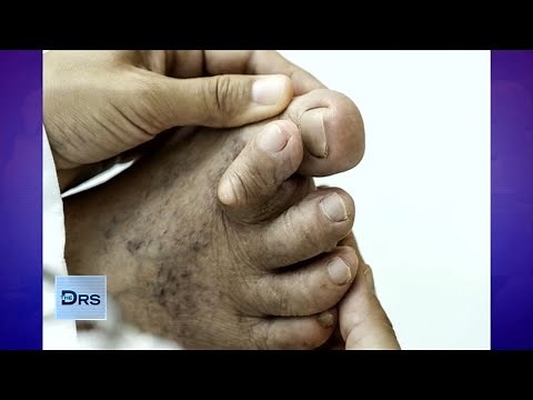 What Are Hammertoes and Why Are They So Painful?