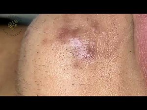 Make your Acne Treatment Dr. Thuy Truong #17 | acne 2023