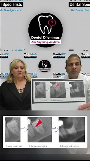 👀 Nerve-Safe Wisdom Tooth Extraction: Try Coronectomy! ⚕️