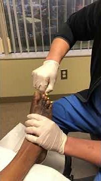 Hammer toe surgery pin removal