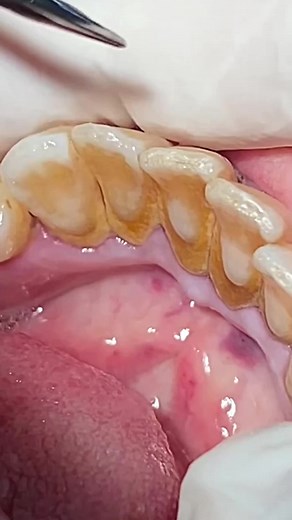 Effective Ways to Remove Tartar and Calculus from Teeth