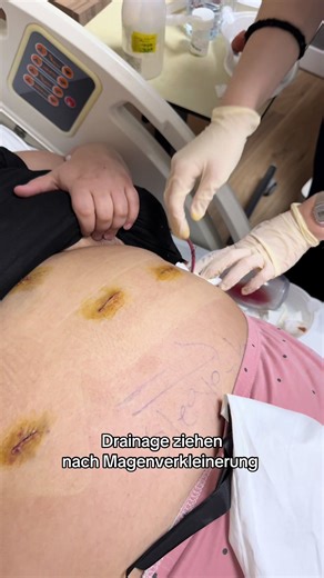 Drainage Removal After Gastric Sleeve Surgery