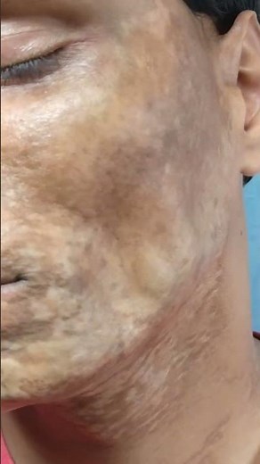 Morphea | Scleroderma | एक साधारण बीमारी भी इलाज के अभाव में काफी ख़तरनाक रूप ले सकती है | #morphea