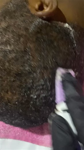 Hair growth/edges repair/anti-dandruff on Instagram: "Folliculitis is on the rise, especially among men. Those tiny painful bumps on your scalp are not something to ignore. What starts small can easily progress into a full-blown scalp infection, leading to inflammation, pus, scalp damage, and eventually hair loss if nothing is done. The earlier you act, the better the outcome. With proper scalp assessment and the right treatment approach, folliculitis can be controlled before it destroys your fo