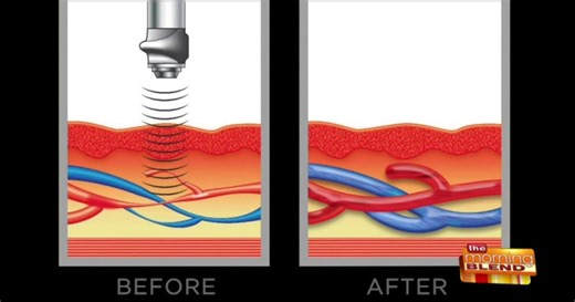 Treating Erectile Dysfunction Without Pills, Injections or Surgery