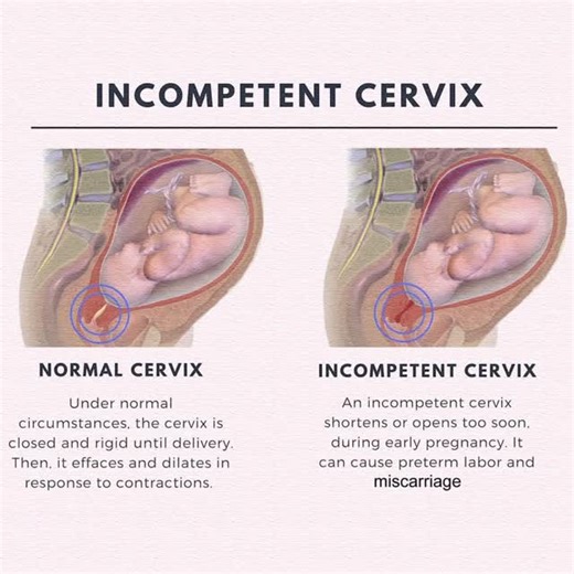 ⚠️ INCOMPETENT CERVIX Condition where cervix weakens & opens too early 🤰 Can cause preterm birth or pregnancy loss 🍼 Often painless, diagnosed via ultrasound or history Managed with cerclage surgery or close monitoring 🏥 💡 Tip: Early prenatal checkups & reporting unusual discharge or pressure help prevent complications. #PregnancyTips #IncompetentCervix #PrenatalCare #HealthyPregnancy | Mum_world_