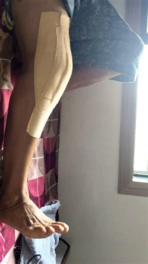 Dr.Drashti | Movement Therapist | Exercise Science Specialist on Instagram: "🔍 What is Quadriceps Lag? Quadriceps lag is inability to achieve full active knee extension, even though full passive extension is possible. It means the quadriceps muscle cannot generate enough force to straighten the knee actively. --- 🧠 Why Does Quadriceps Lag Happen? 🔹 Disuse atrophy of quadriceps (commonly post-op or post-injury) 🔹 Pain inhibition (due to swelling, effusion) 🔹 Nerve injury (e.g., femoral nerve