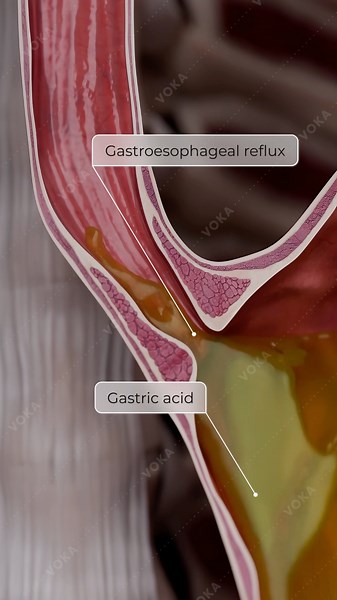 Erosive Esophagitis 3D Animation: Causes, Symptoms & Treatment | GERD, Acid Reflux