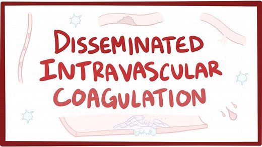 Disseminated intravascular coagulation: Video, Causes, & Meaning | Osmosis