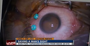 Brain-Eating Parasitic Tapeworm Embeds Itself in Florida Man's Eye