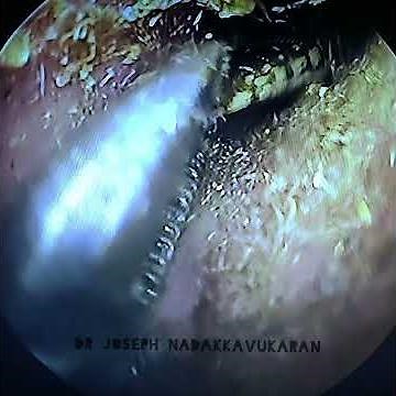 Removing a bug alive, from the ear..watch till the end!!