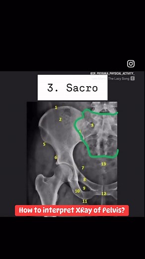 245K views · 2.9K reactions | How to interpret X-ray of Pelvis? | Medical Talks | Facebook