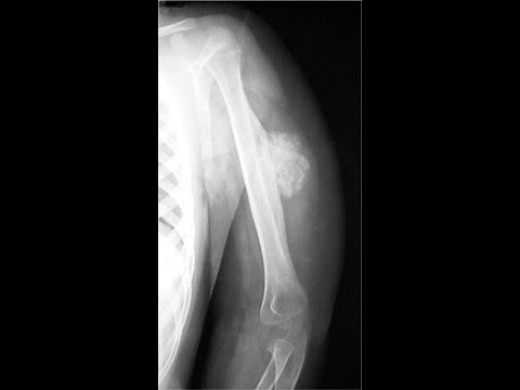 Myositis ossificans: Causes, Symptoms, and Treatment; Diagnostic Imaging