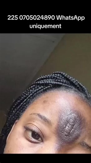 🌿 Dites adieu aux cicatrices et boutons persistants ! 🌿 Découvrez notre duo médical de choc : ✨ Spray Anti-Cicatrice (Medical Grade)   Lotion Rapid Acné ✨ ✅ Élimine efficacement les cicatrices d’acné, coupures, brûlures ou vergetures ✅ Assèche rapidement les boutons et prévient leur réapparition ✅ Formules professionnelles et testées ✅ Convient à tous types de peaux 💥 Résultats visibles dès les premières semaines ! 📦 Le Duo Complet à seulement 20.000 FCFA 📲 Commandez maintenant via WhatsApp