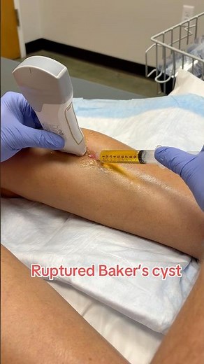 Draining a ruptured Baker’s cyst #tiktokdoctor #sportsmedicine #medstudent #premed #bakerscyst ￼
