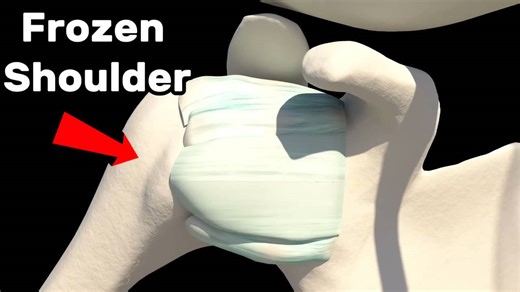 Frozen shoulder how to fix it - Causes and treatments