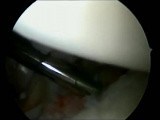 Bankart and Slap Repair Shoulder • Video • MEDtube.net