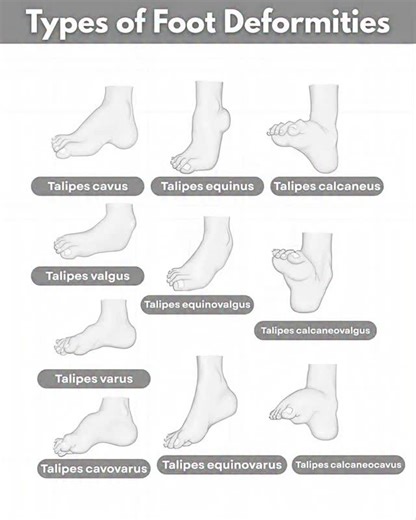 The healing tribes 🏥 on Instagram: "🔹All types of Foot Deformities (Talipes) ✔️ Talipes cavus → High arch of the foot (exaggerated plantar flexion of forefoot). ✔️ Talipes equinus → Plantarflexed foot; patient walks on toes (cannot dorsiflex). ✔️ Talipes calcaneus → Dorsiflexed foot; patient walks on heel (cannot plantarflex). ✔️ Talipes valgus → Foot everted (turned outward at heel). ✔️ Talipes equinovalgus → Combination of plantarflexion + eversion. ✔️ Talipes calcaneovalgus → Combination of
