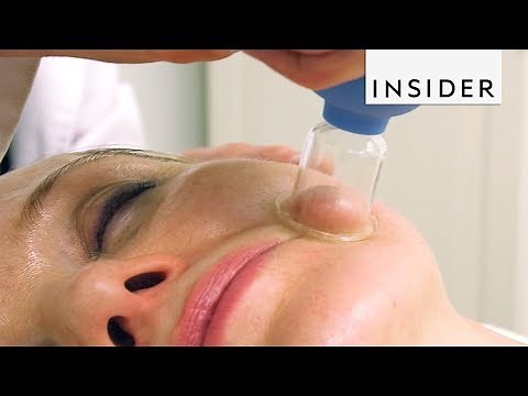 Face Cupping Gives Instant Facelift