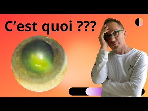 Kératites, Ulcères et abcès de cornée (Maladie des yeux)