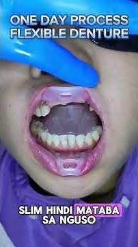 ✨ONE DAY PROCESS FLEXIBLE DENTURE✨