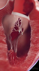 The mitral valve regulates blood flow between the left atrium and left ventricle — allowing oxygen-rich blood to enter the heart’s main pumping chamber. During diastole, the valve opens to let blood flow into the ventricle. During systole, it closes tightly to prevent backflow into the atrium. Its two leaflets are anchored by chordae tendineae and papillary muscles, which prevent valve prolapse under pressure. This 3D animation shows the mitral valve in motion — guiding blood through the heart. 