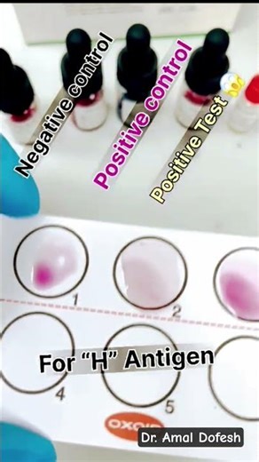 Salmonella Typhi Widal test Quality control Microbiology laboratory medical laboratory